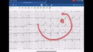 Sgarbossa Criteria Example Paced Rhythm [upl. by Kimmie]