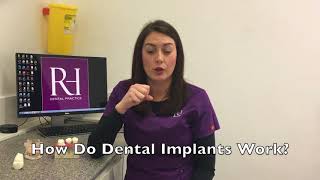 Dental Implant Information at Rock House Dental Practice [upl. by Peppie]