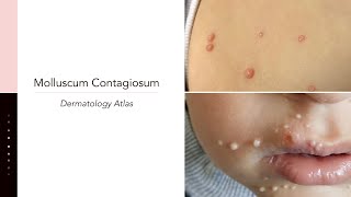 Molluscum Contagiosum [upl. by Garett]