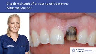 Discolored teeth after root canal treatment  what can you do [upl. by Ynohtona]