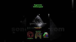 Ecocardiografía  Hipocinesia Inferolateral E Inferior [upl. by Orran84]