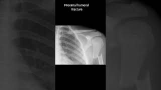 Proximal humeral fracture xrayshoulder [upl. by Tucky]