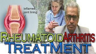 Rheumatoid Arthritis in Hindi  Discussion and Treatment in Homeopathy by Dr PS Tiwari [upl. by Means288]