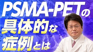 PSMAPET検査ってどんな人が実施すると良いの？わかりやすく解説 [upl. by Hadias]