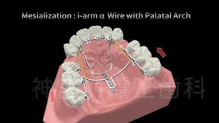 Mesialization [upl. by Parsons]