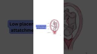 Low Lying Placenta in Pregnancy  Normal Delivery With Placenta ka Nichy hona Nuksan ya Faida [upl. by Amick]