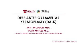 Deep Anterior Lamellar Keratoplasty DALK [upl. by Asik]