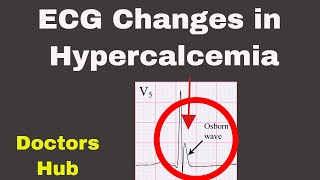 Hypercalcemia ECG Changes [upl. by Mohsen605]