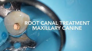 Root Canal Treatment on Maxillary Canine Tooth 23 [upl. by Horgan49]