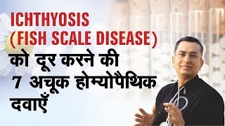 Icthyosis  होम्योपैथिक उपचार [upl. by Yramanna899]