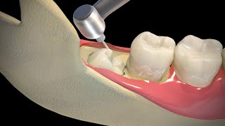 Wisdom Teeth Extraction  Step by step [upl. by Adlen]