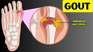 Understanding Gout  Causes Risk Factors Signs amp Symptoms Diagnosis amp Treatment [upl. by Leraj]