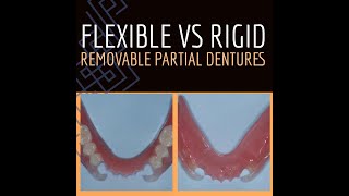 V2538 Flexible vs Rigid Removable Partial Dentures [upl. by Budding]