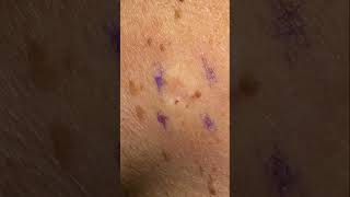 Age Spot Removal  Completely Gone [upl. by Graniah]