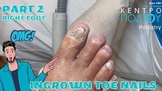 Ingrown ToenailΕίσφρυση όνυχος callus κεντροποδιου footcare podologos podiatrist podiatry [upl. by Lusar79]