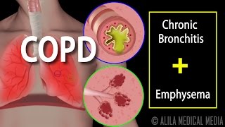 COPD  Chronic Obstructive Pulmonary Disease Animation [upl. by Bidget]