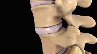 Back Pain Lumbar Disc Injury [upl. by Nyrroc]