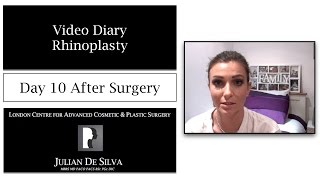 6 Rhinoplasty amp Septoplasty Video Diary Day 10 After Surgery [upl. by Ihculo]