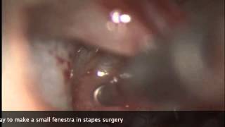 The Skeeter Drill in Stapes Surgery [upl. by Dyan]