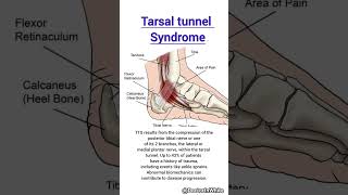 Tarsal tunnel syndrome  Tibial nerve  viralshort tarsaltunnel syndrome tibial [upl. by Gayle]