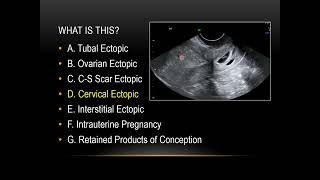 First trimester obstetrical ultrasound part 2 usual locations of ectopic pregnancy [upl. by Ainivad868]