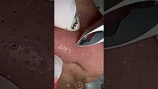 Skincare  Blackheads Removal 274 tweezers skincare blackheads blackheads [upl. by Ramos521]