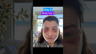 EPIC FACELIFT TRANSFORMATION Journey [upl. by Aroved]