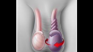 Testicular Torsion [upl. by Melleta]