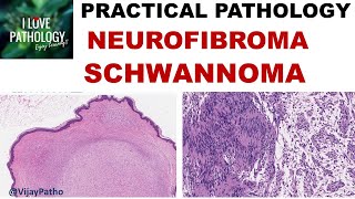 NEUROFIBROMA AND SCHWANNOMA Clinical features amp Morphology [upl. by Lovato]