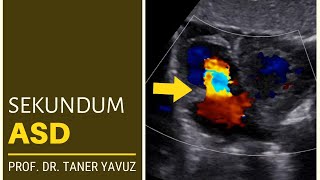 Sekundum ASD  Ekokardiyografi [upl. by Ellesij618]