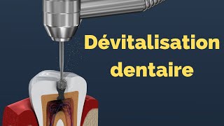 ⭕ Devitalisation dent ou Étape dEndodontie  carie dentaire [upl. by Yttak]