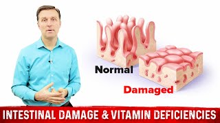 Intestinal Obstruction amp Vitamin Deficiencies – Dr Berg [upl. by Frodeen]