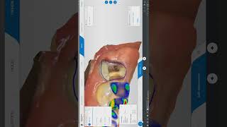 Deep Margin elevation with Cerec Endocrown with digital impression shorts short dental dentistry [upl. by Melodee]