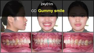 Class I Deep Bite with Gummy Smile｜【Chris Chang Ortho】CC799 [upl. by Anih]