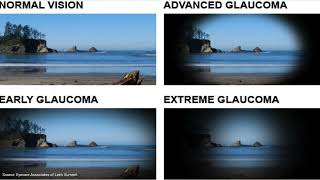 Glaucoma  An Introduction for Patients [upl. by Hale]