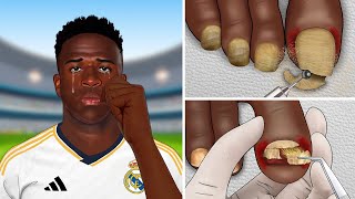 ASMR Vinícius Jr treat his feet  perennial toenail removal [upl. by Bosch429]