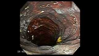 Colonoscopy of Severe Melanosis Coli [upl. by Finley30]