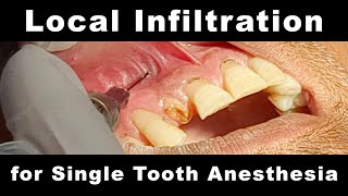 Local Infiltration  Single Tooth Anesthesia [upl. by Yvon940]