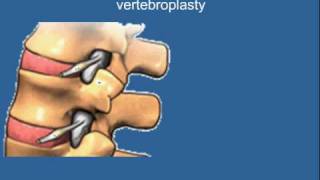 Vertebroplasty [upl. by Albarran]