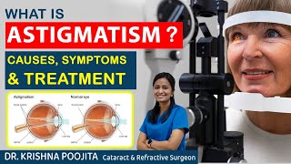 What is Astigmatism  Astigmatism Causes amp Treatment  Dr Krishna poojita  Pixel eye hospital [upl. by Beane]