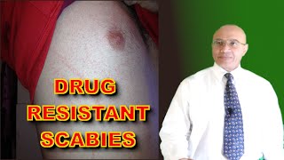 Scabies Drug Resistance Emerging [upl. by Anitnelav]