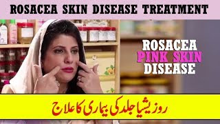 Rosacea Skin Disease Treatment by Dr Bilquis Shaikh  Rosacea Gulabi Skin Disease [upl. by Lednor]