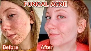 FUNGAL ACNE  How I Knew I had it  How I cleared it  Signs of fungal acne and products to use [upl. by Auqenes767]