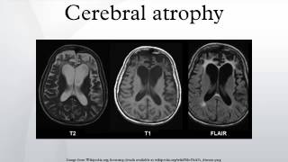 Cerebral atrophy [upl. by Nottarts532]