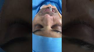 Radix and alar base reduction nose contouring surgery [upl. by Harol923]