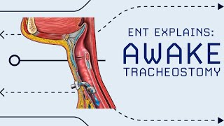 Awake Tracheostomy Explained Emergency Airway in OR [upl. by Aicnarf]