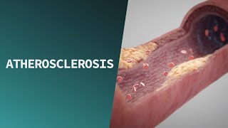 Atherosclerosis  Pathologies [upl. by Eiramave820]