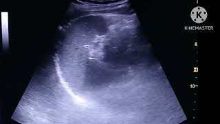 Ureteric stone on Ultrasound [upl. by Aiker]