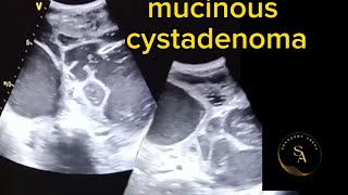 Ultrasound Imaging mucinous Cystadenoma [upl. by Nosna]