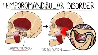 Temporomandibular Joint Disorder Explained TMJ Dysfunction  Includes Treatment amp Anatomy [upl. by Oakley50]